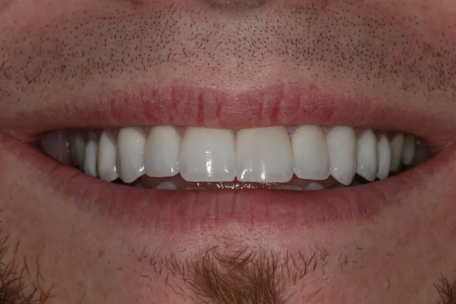 After (close-up), 10 Porcelain Veneers: Zach