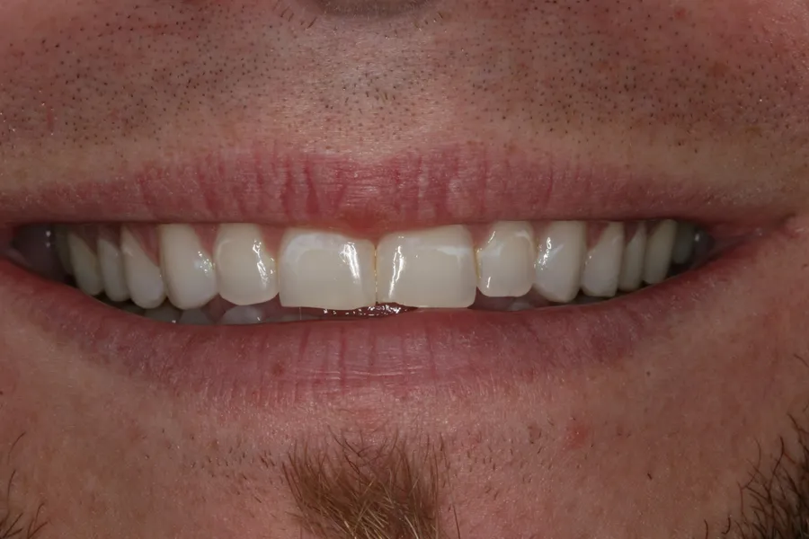 Before (close-up), 10 Porcelain Veneers: Zach