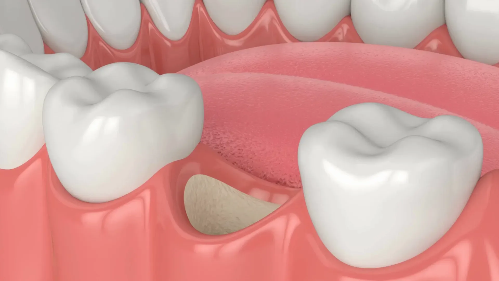 By Getting Dental Implants, Can I Avoid Jawbone Resorption?