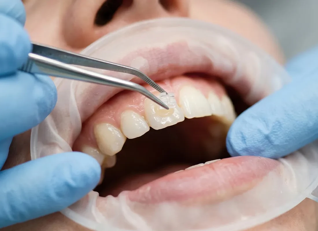 Signs you may need dental bonding