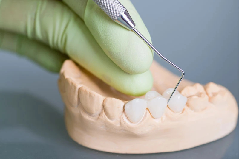 How Is My Smile Restored With A Dental Bridge?