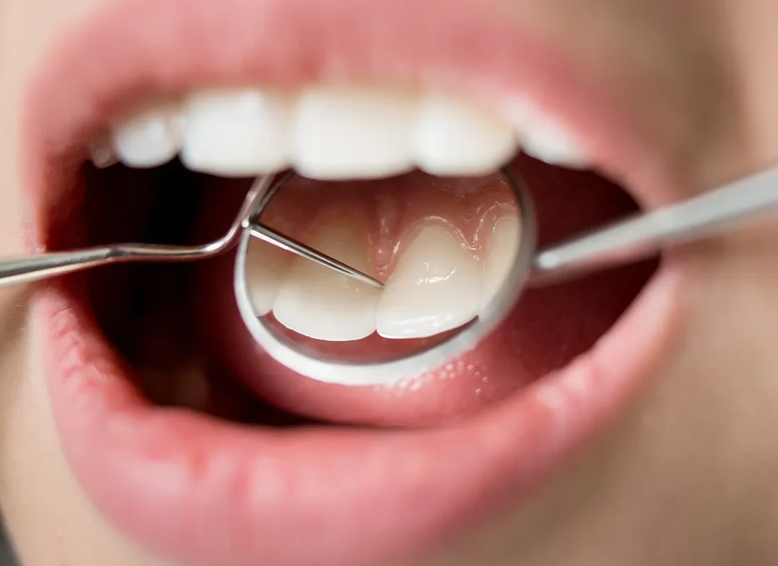 Signs you may need teeth cleaning (prophy)
