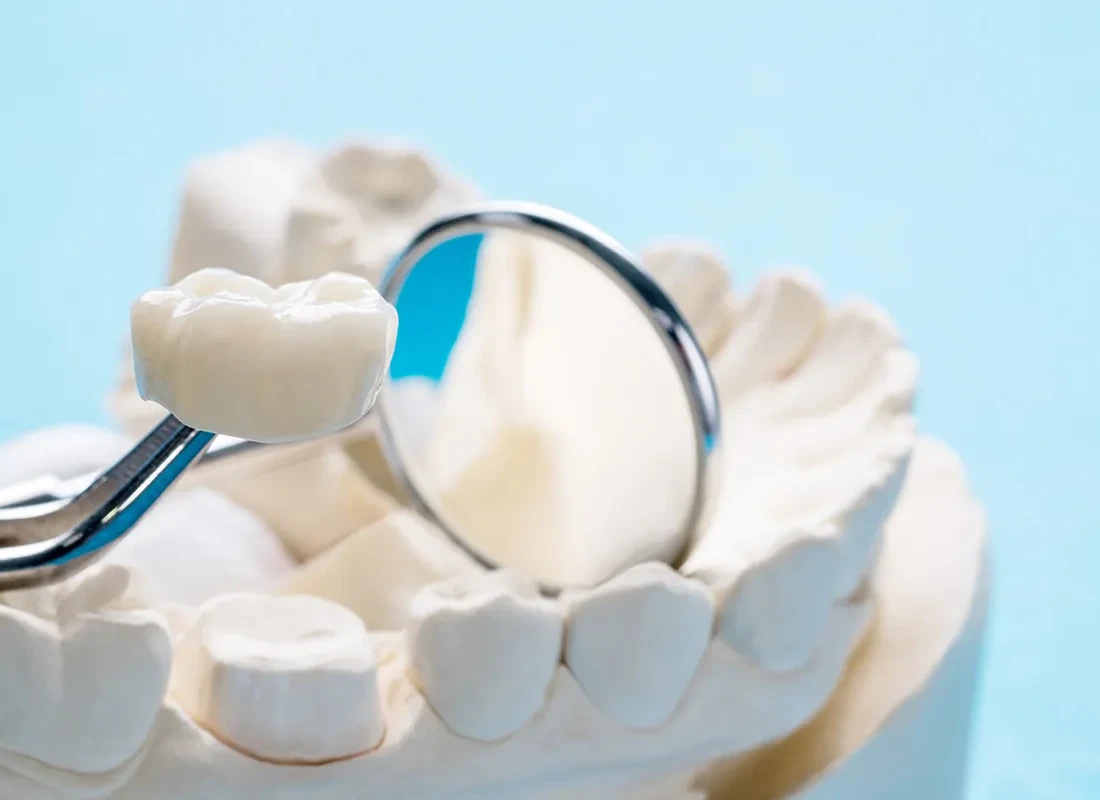 What Makes Me A Candidate For Crowns And Bridges?