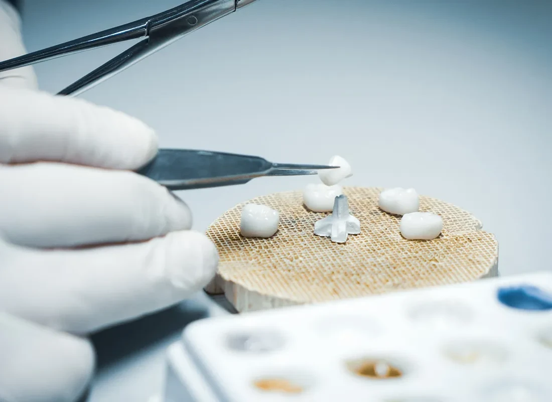 Dental Bridge Vs Implant: Which Is Right For Me?