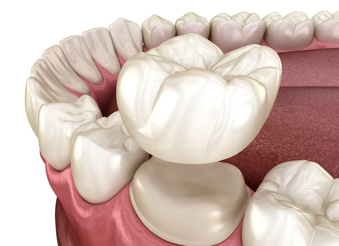 After Getting Crowns Or Bridges, How Do I Take Care Of Them?