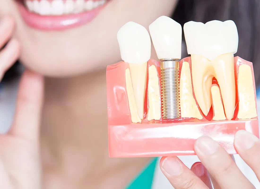 Full-Mouth Dental Implants Options In Salt Lake City, UT!