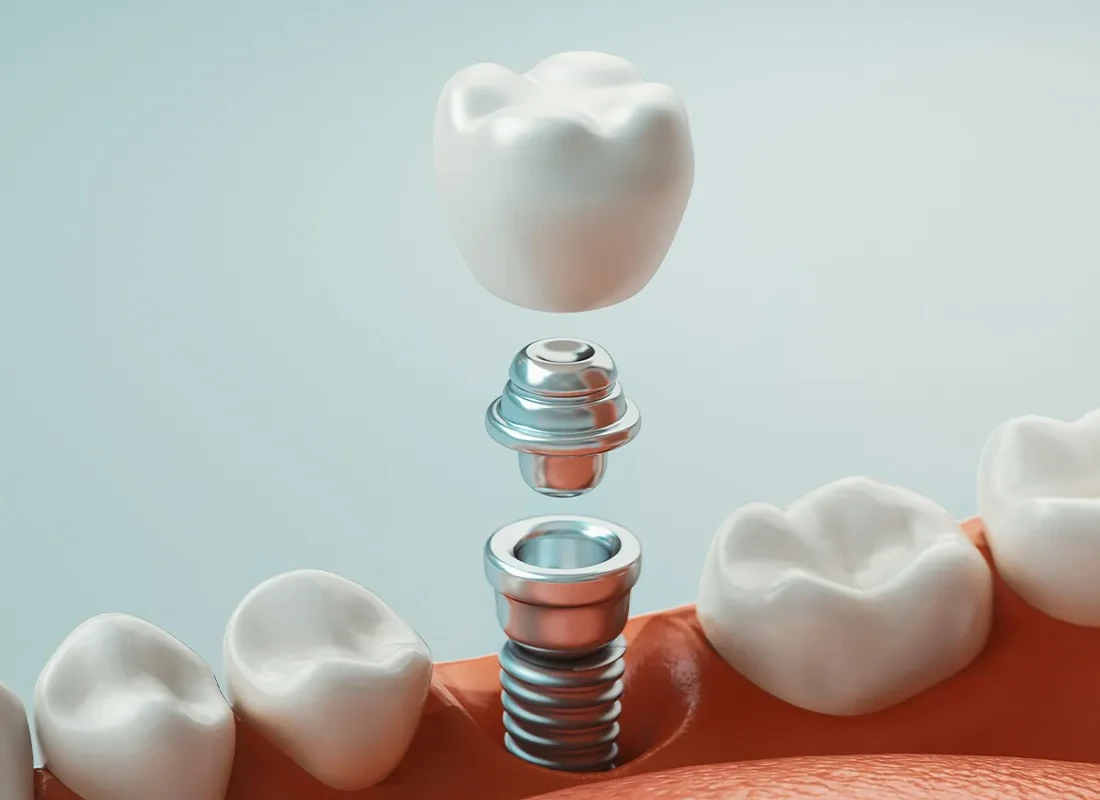 What Are The Benefits Of Dental Implants?