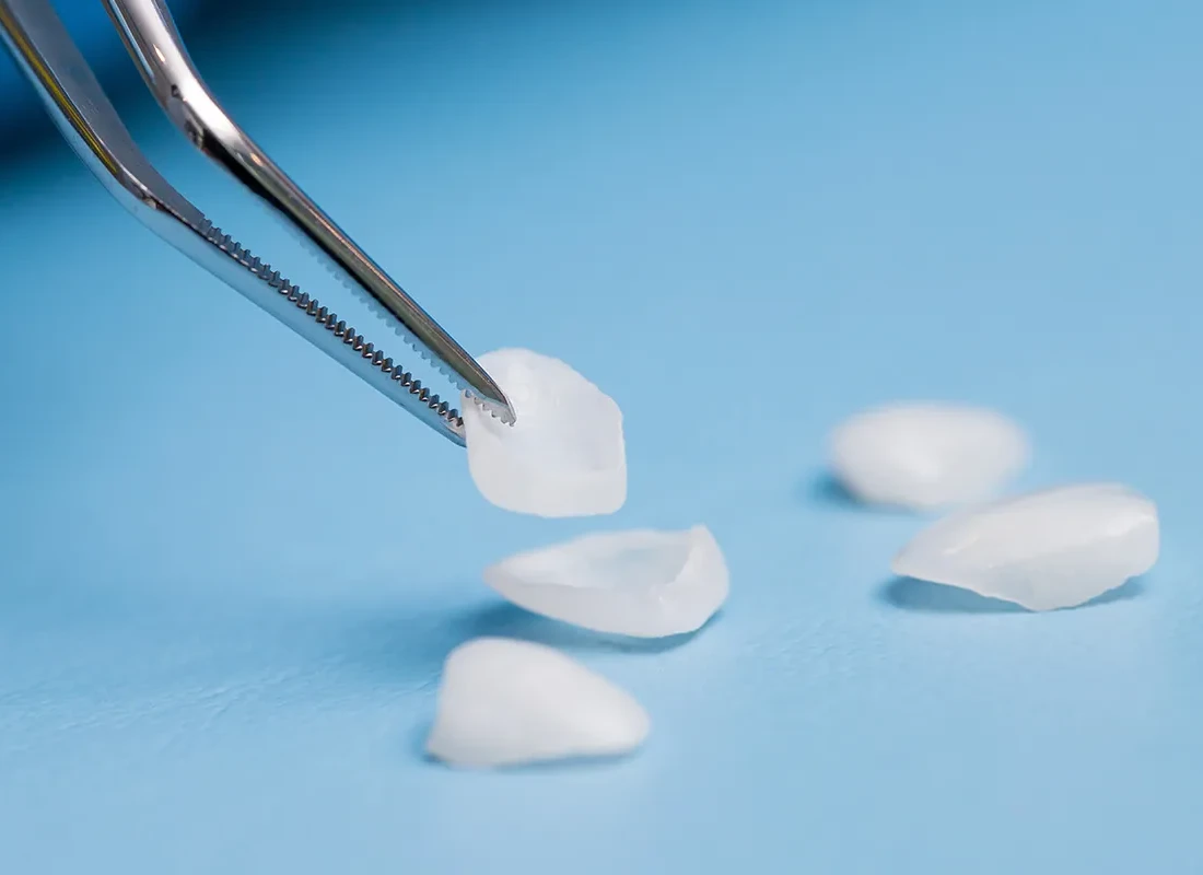Am I Able To Get Treated With Personalized Porcelain Veneers In Salt Lake City, UT?
