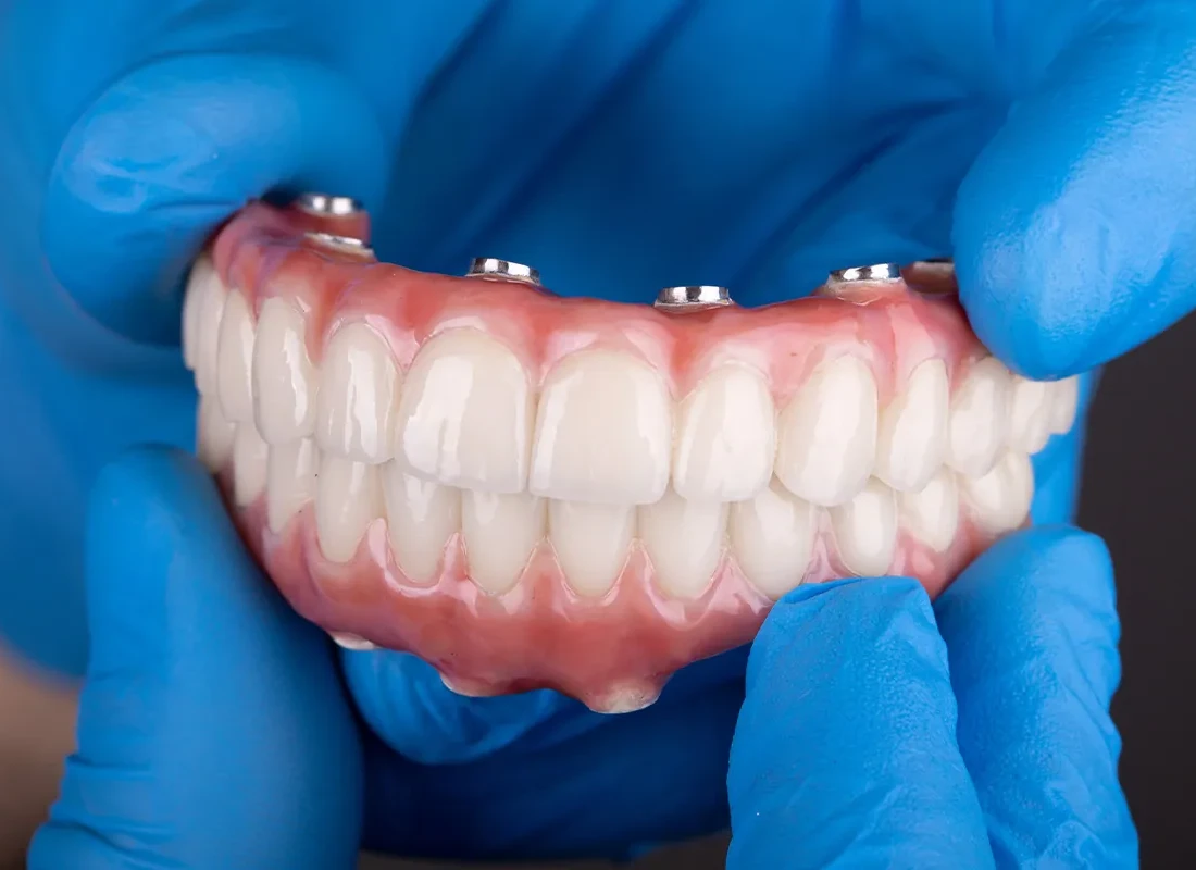 Is There A Difference Between Implant Supported Dentures And Full Mouth Dental Implants?