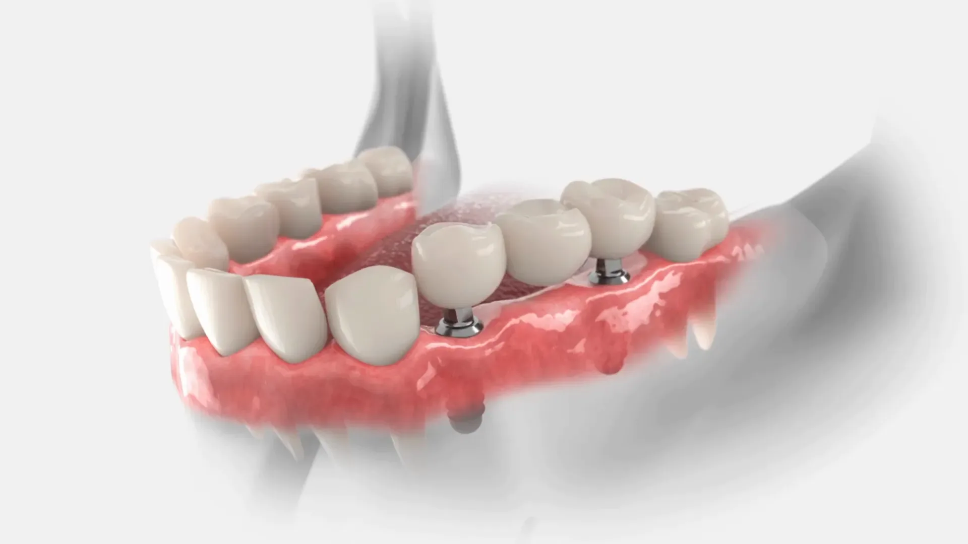 When Is Dental Implant Surgery Needed?