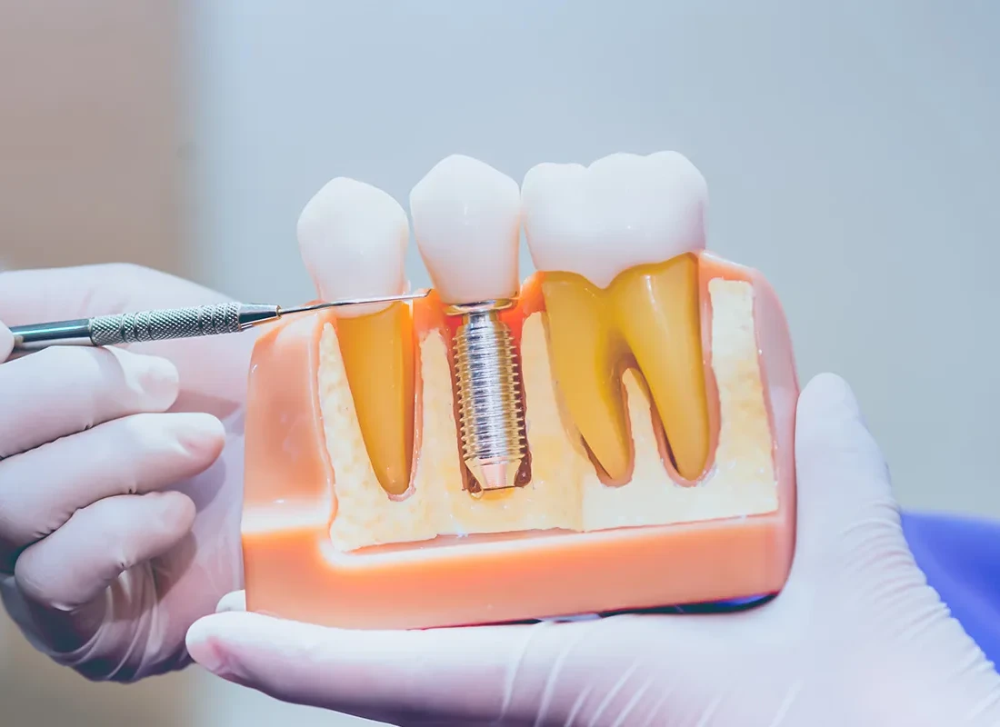 The Parts That Compose A Dental Implant And How The Dental Implant Is Placed