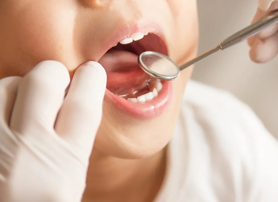 What is Fluoride Treatments