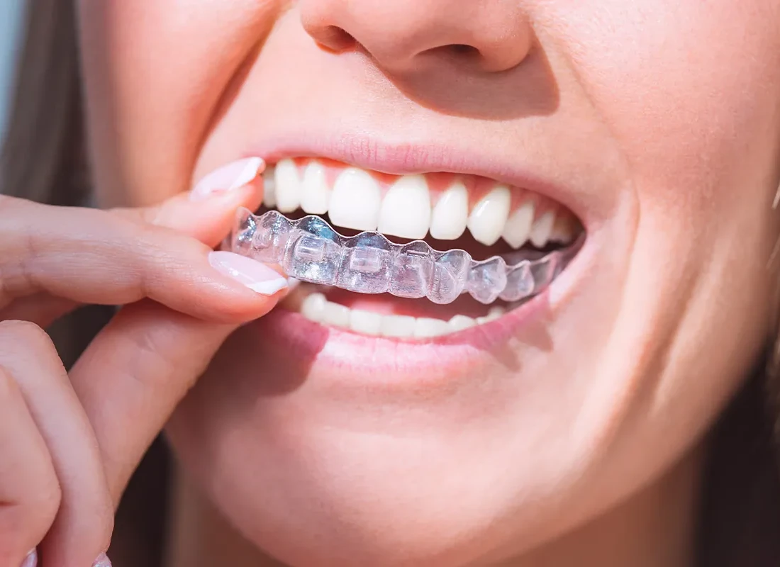 Signs you may need sports mouthguards
