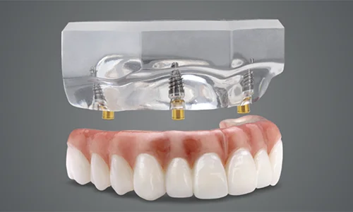 Zest Locator Fixed Bridge