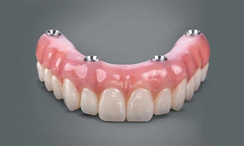 Locator Implant Overdenture