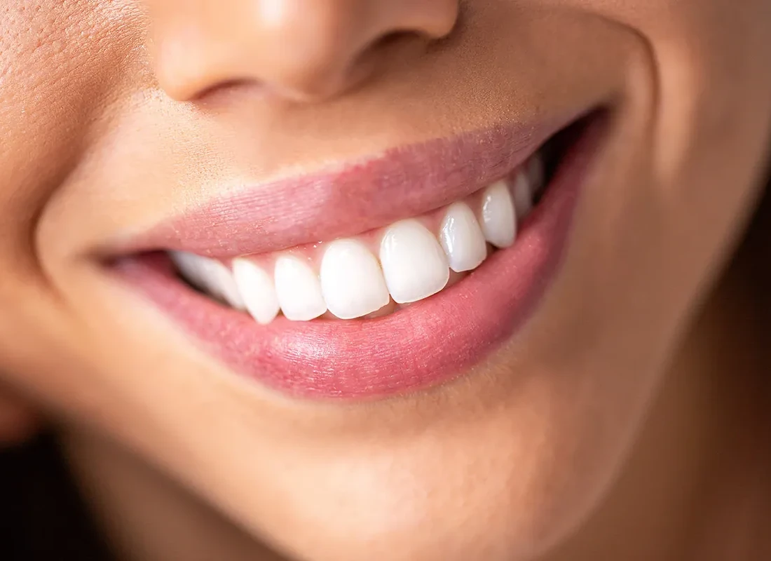 Smile Makeover at Rod Gleave, DMD