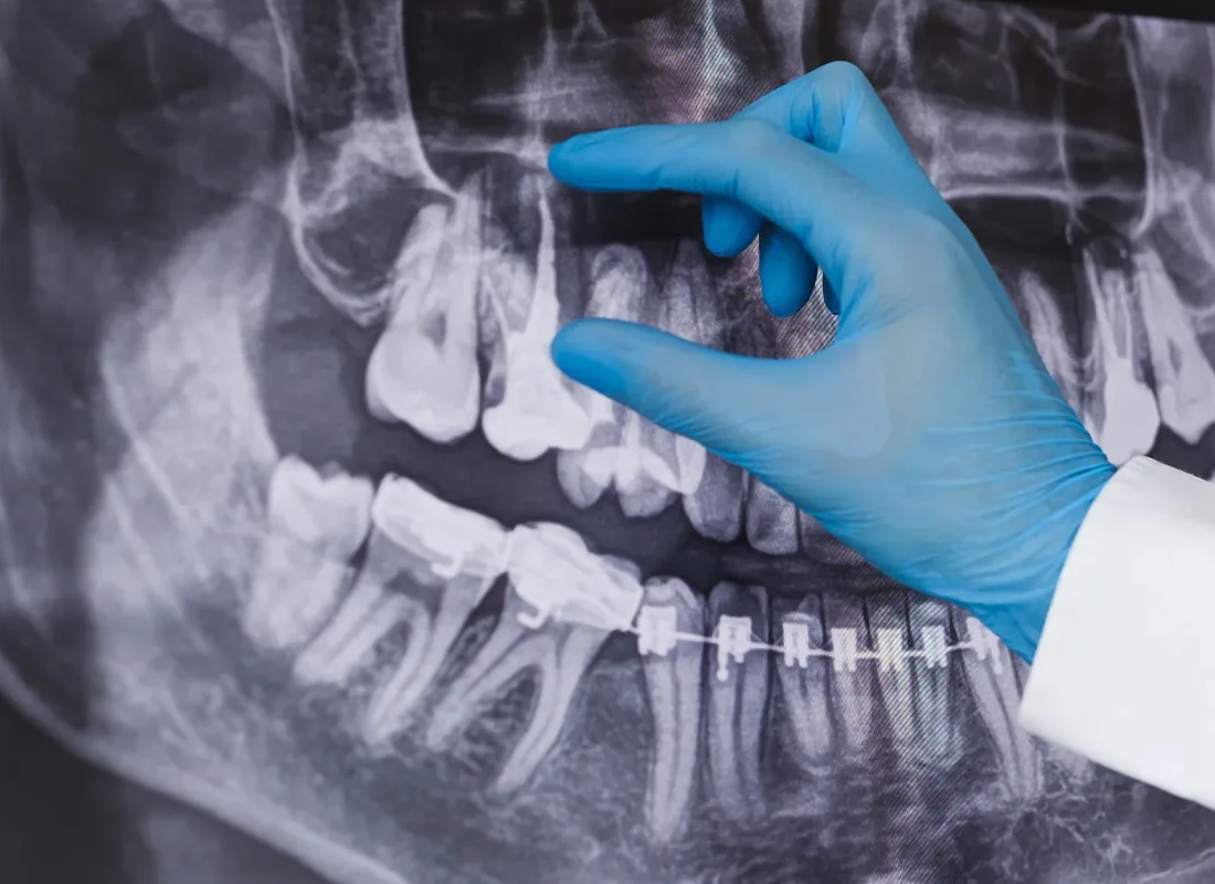 Root Canal at Rod Gleave, DMD