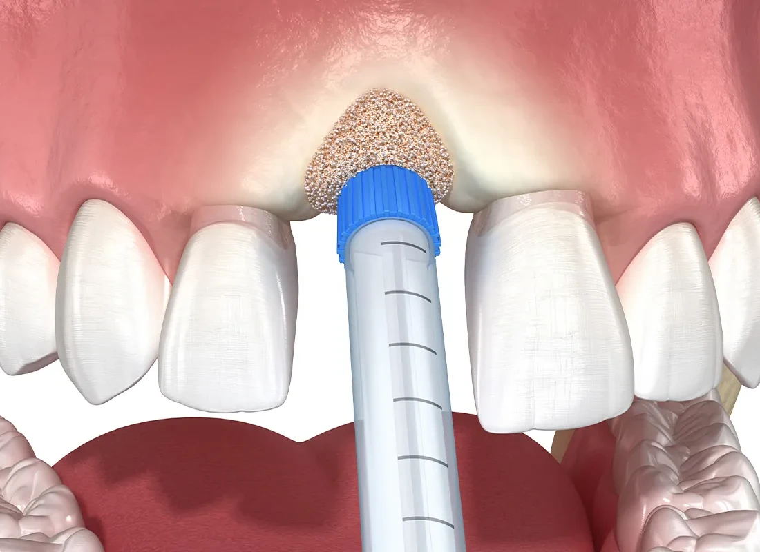 Do I Need Bone Grafting Before A Dental Implant Treatment?