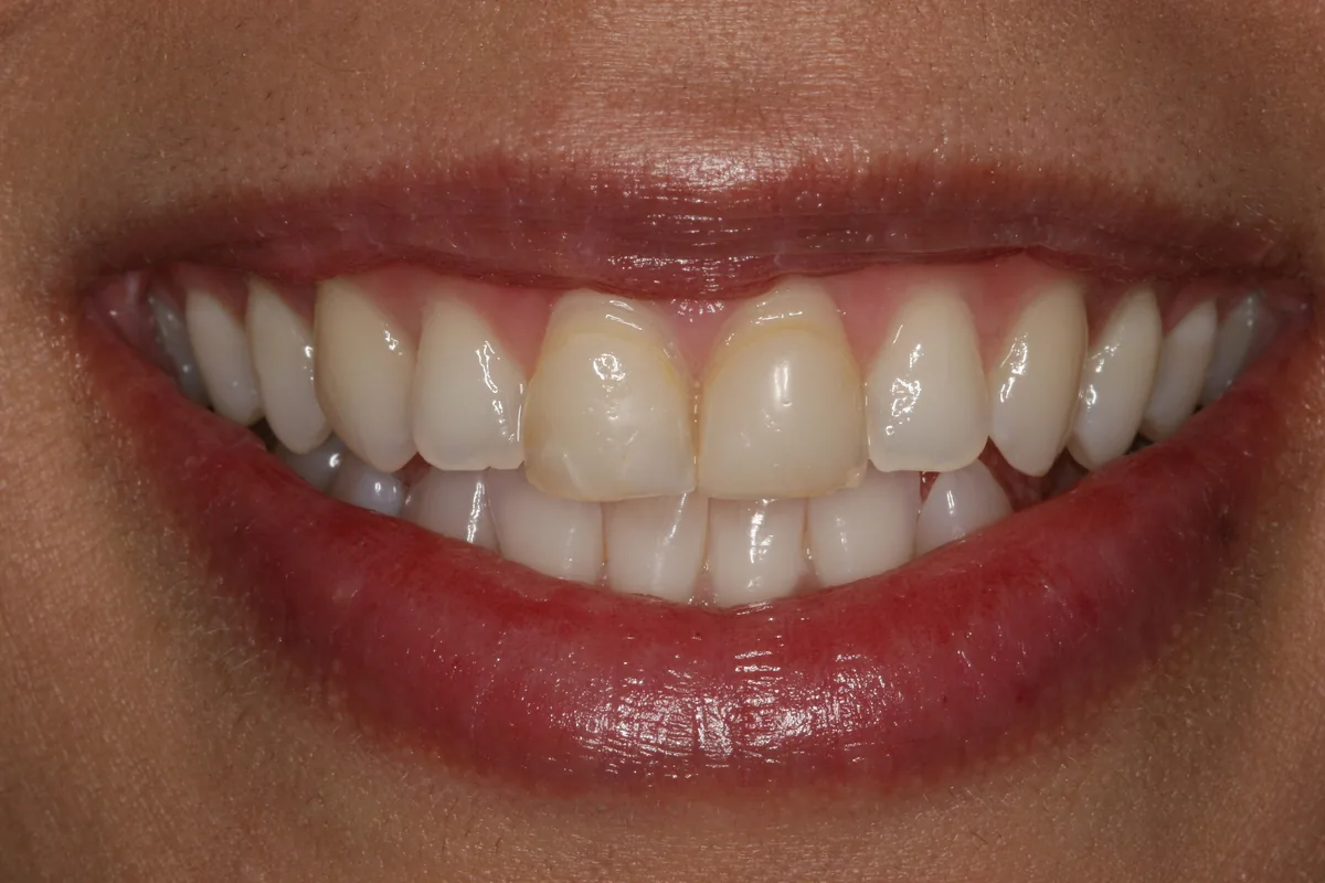 Before (close-up), 2 Layered Porcelain Veneers: Anisa