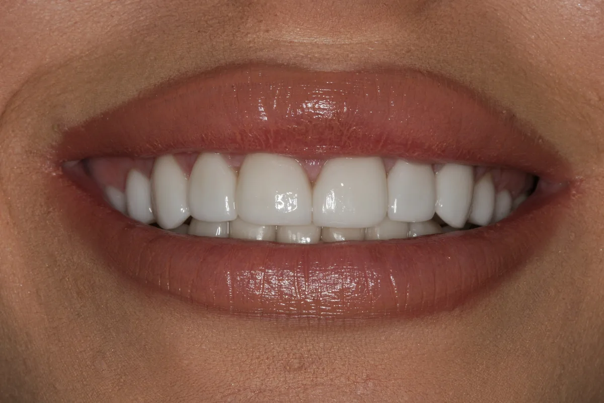 Ayla's smile transformation at Rod Gleave, DMD, after