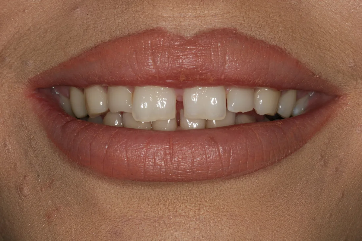 Ayla's smile transformation at Rod Gleave, DMD, before