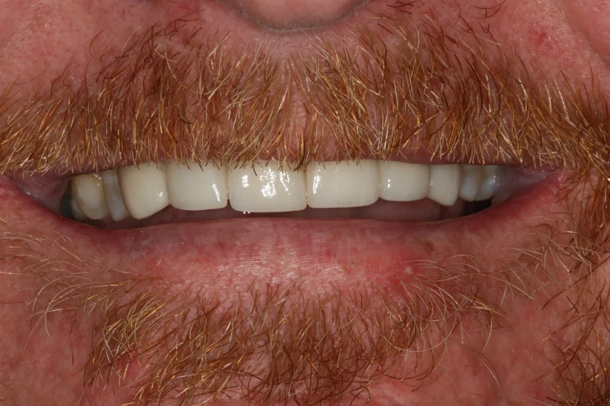 After (close-up), 12 Porcelain Veneers: Brad