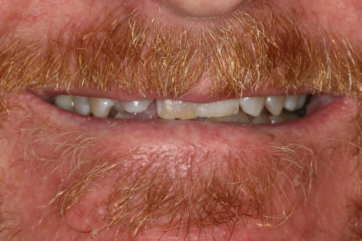 Before (close-up), 12 Porcelain Veneers: Brad
