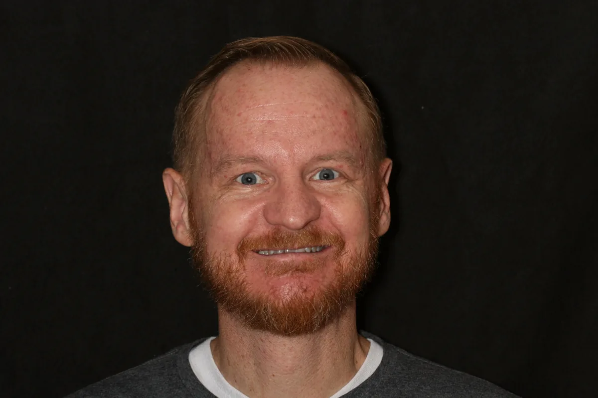 Before, 12 Porcelain Veneers: Brad
