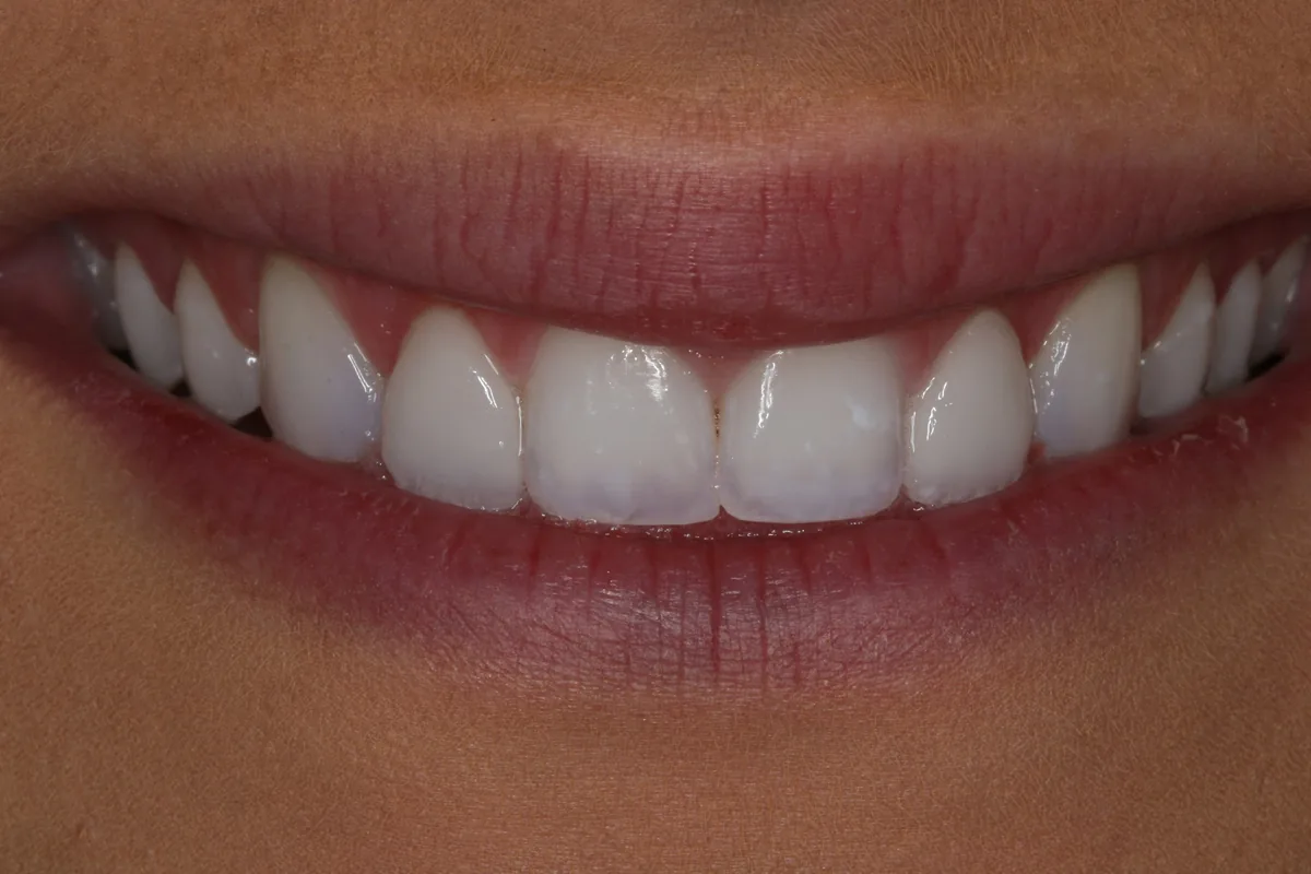Retracted view, after: 2 No-Prep Veneers: Carli