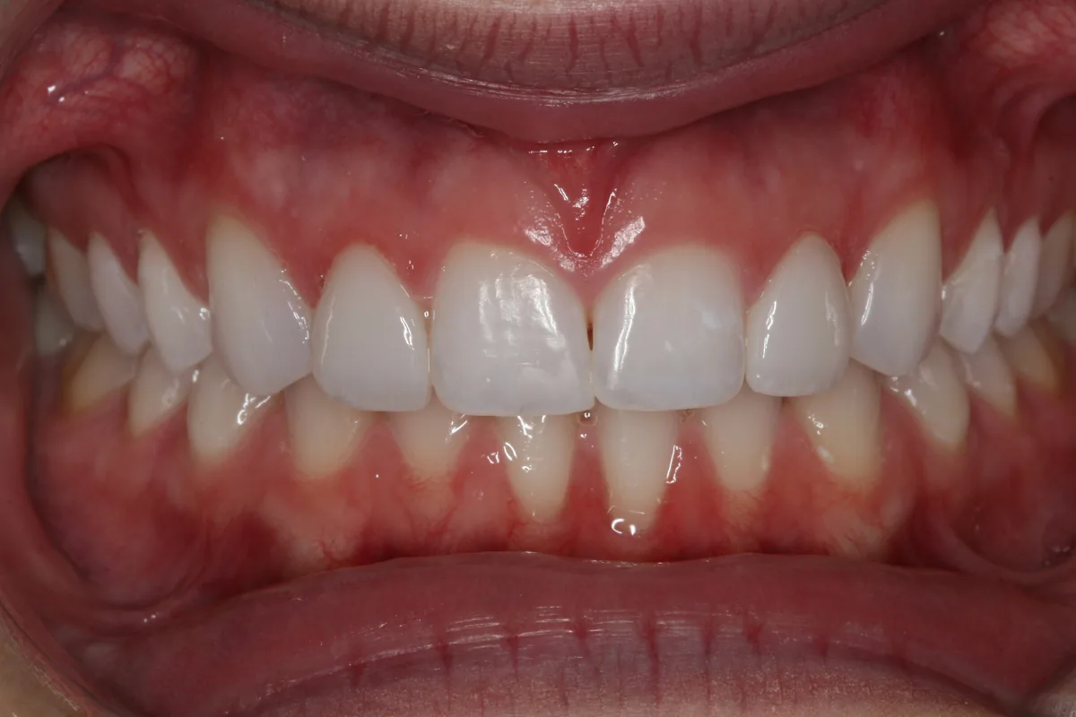 After, 2 No-Prep Veneers: Carli