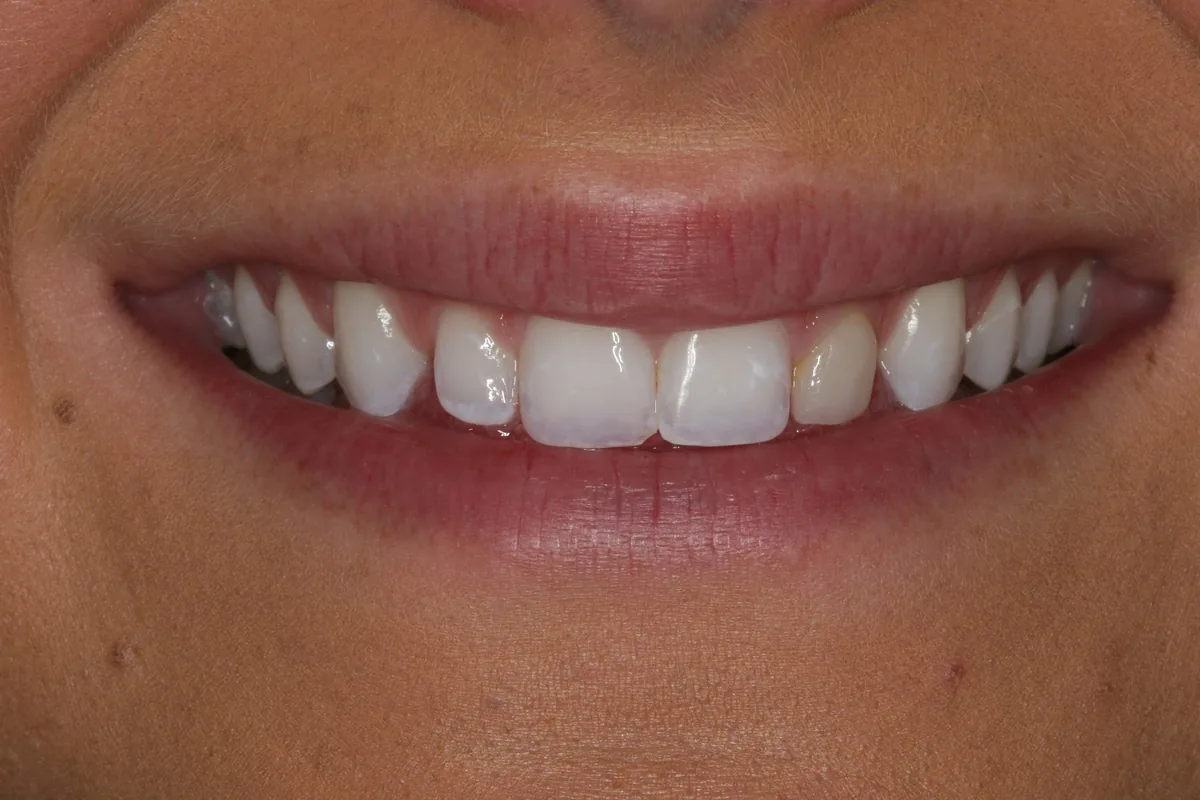 Retracted view, before: 2 No-Prep Veneers: Carli