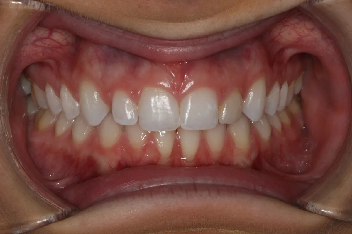 Before, 2 No-Prep Veneers: Carli