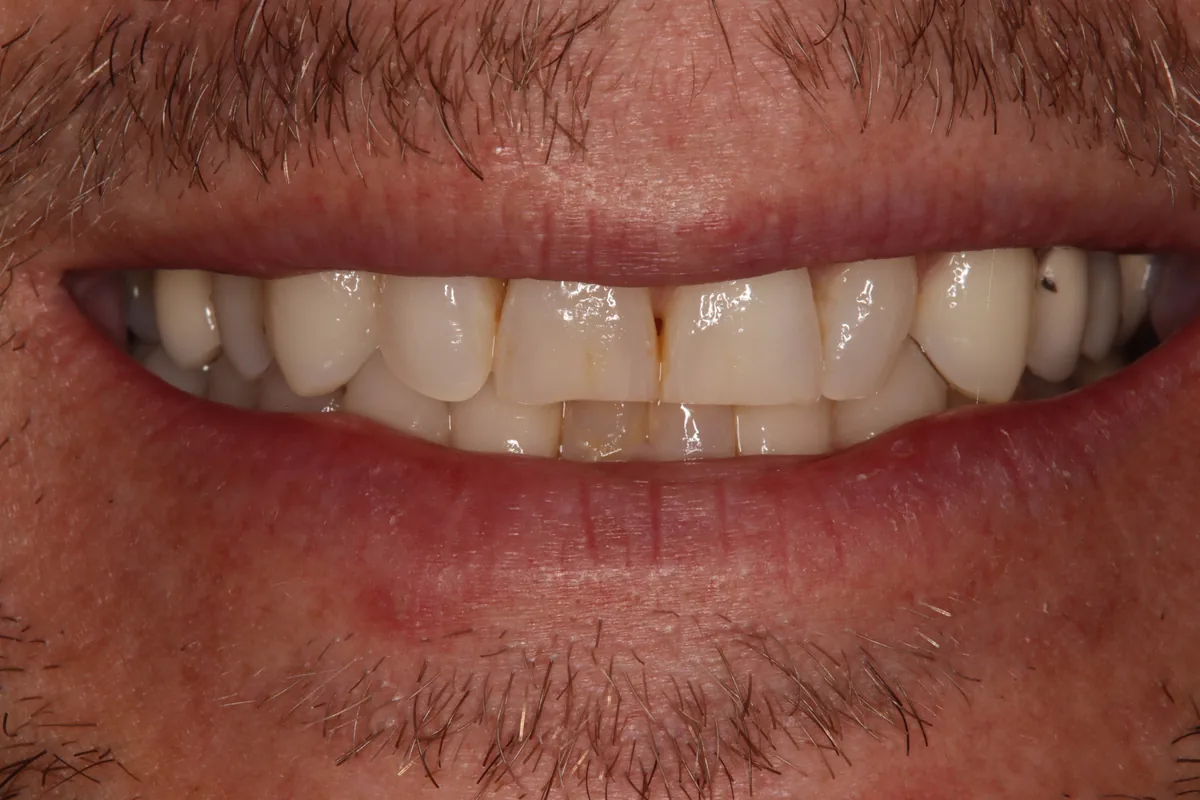 Before (close-up), 18 Veneers + 2 Esthetic Crowns: Clint