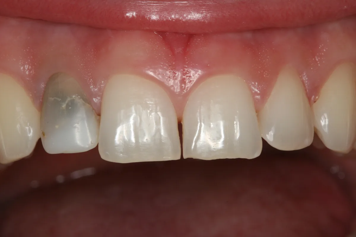 Before, 1 Esthetic Porcelain Crown: Cody