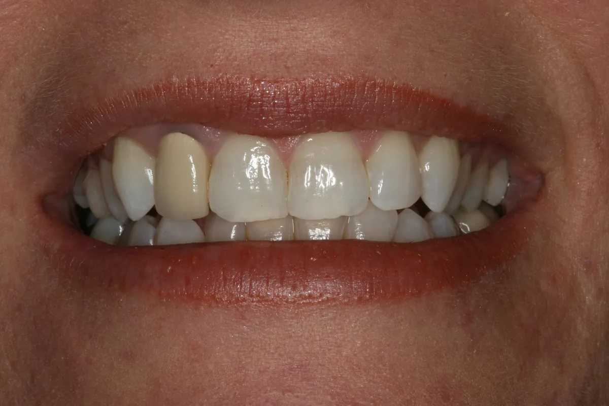 Before (close-up), 1 Esthetic Porcelain Crown: Dawn