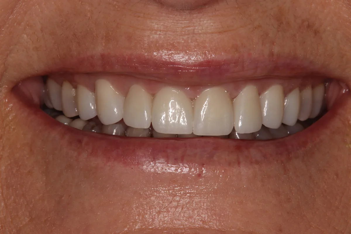 After (close-up), 8 Esthetic Crowns: Heidi