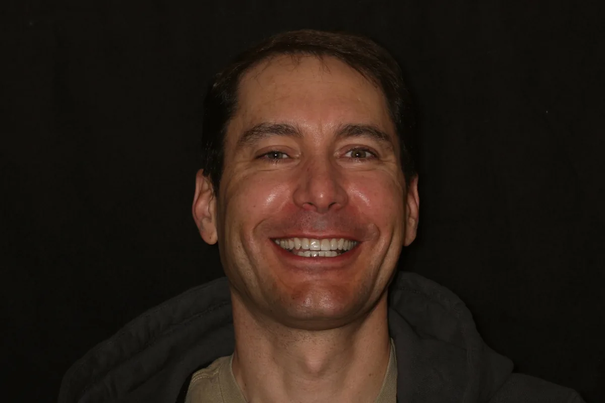 After, 4 Layered Porcelain Veneers: John