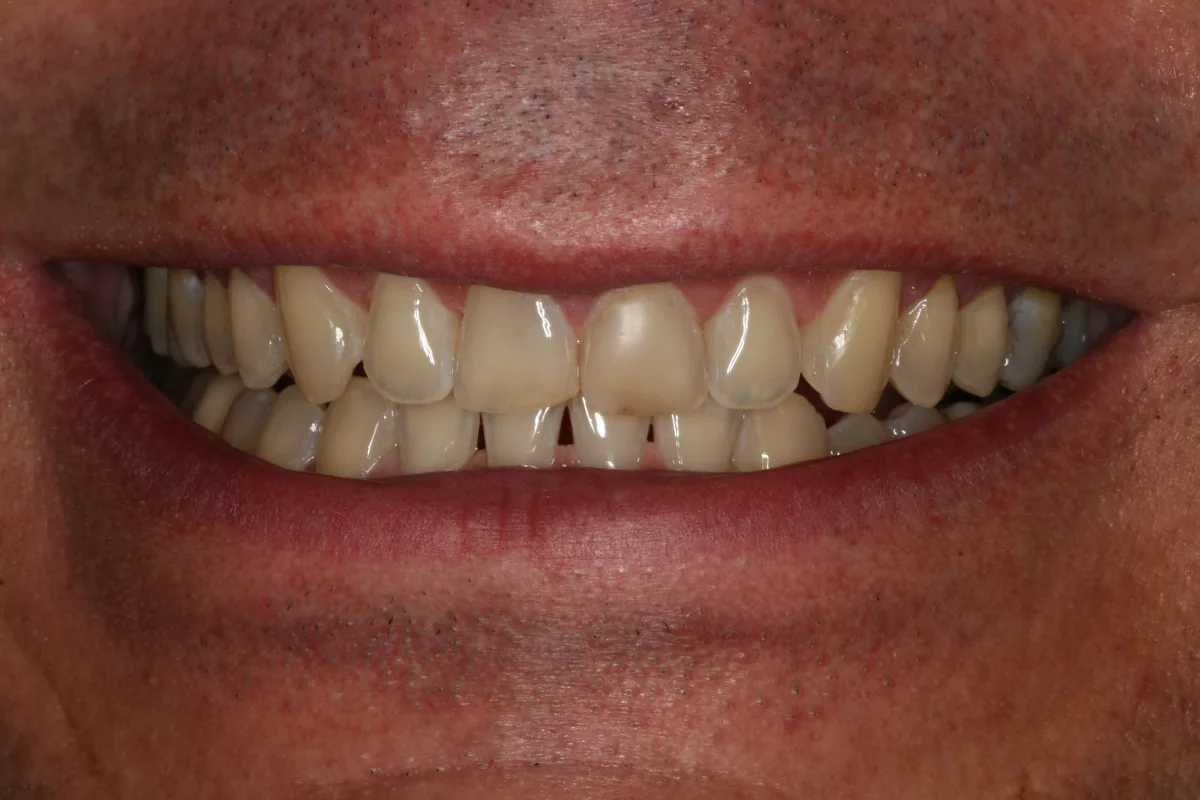 Before (close-up), 4 Layered Porcelain Veneers: John