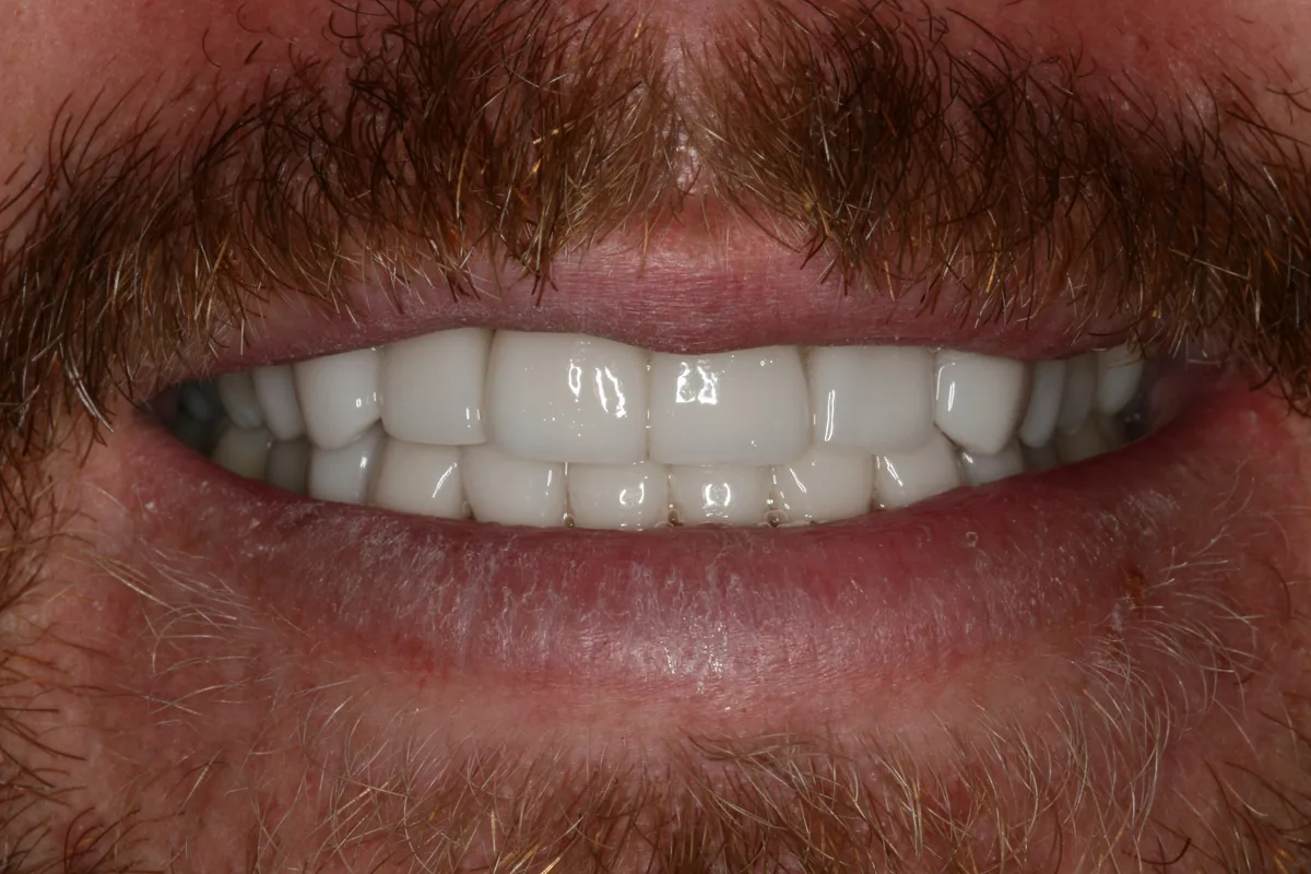Jon's smile transformation at Rod Gleave, DMD, after