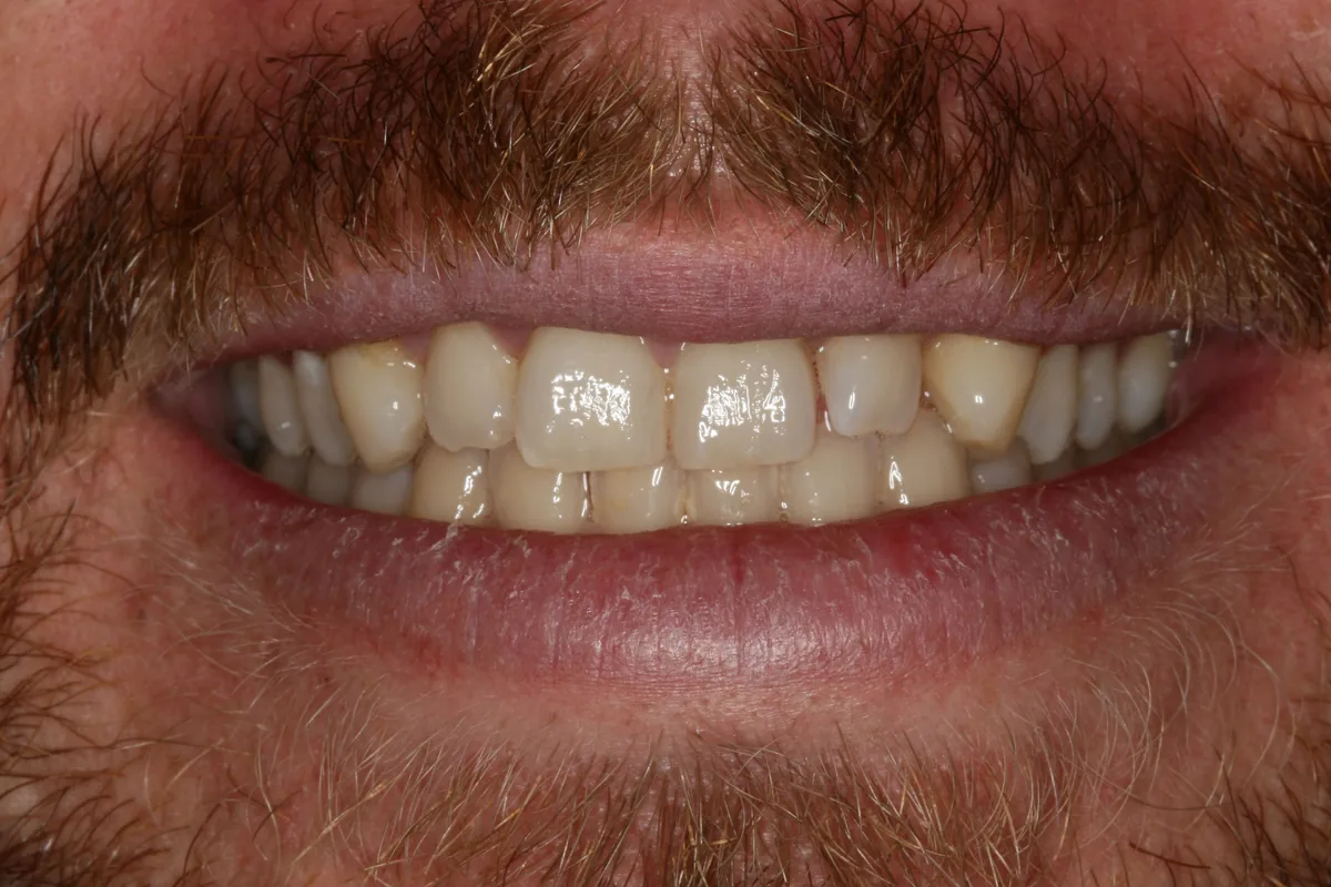 Jon's smile transformation at Rod Gleave, DMD, before