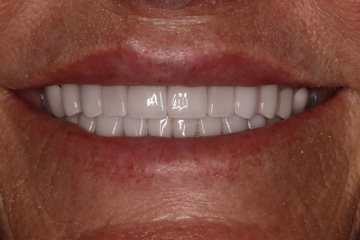 After (close-up), 14 Veneers + 4 Porcelain Crowns: Kelly