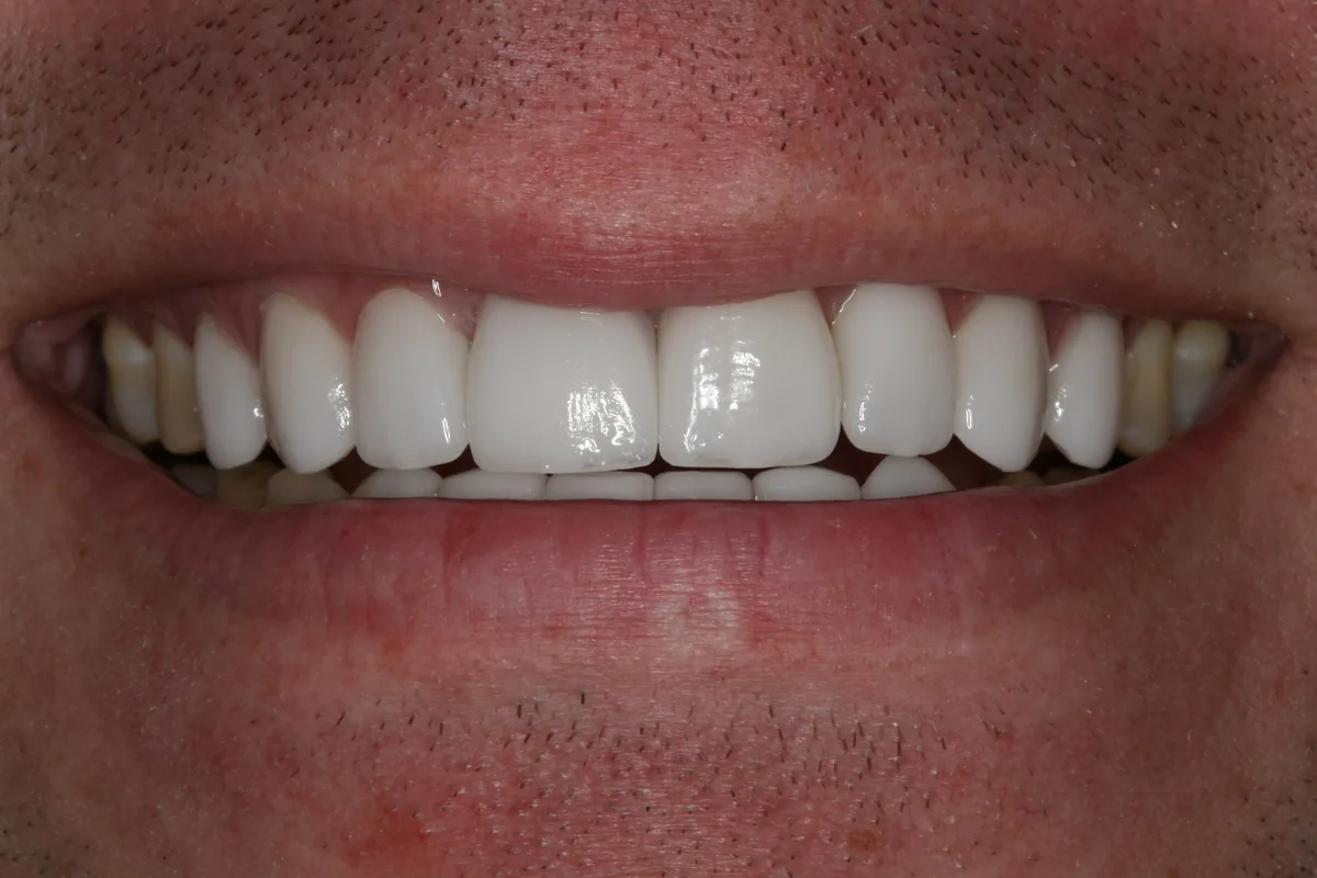 Kenny's smile transformation at Rod Gleave, DMD, after