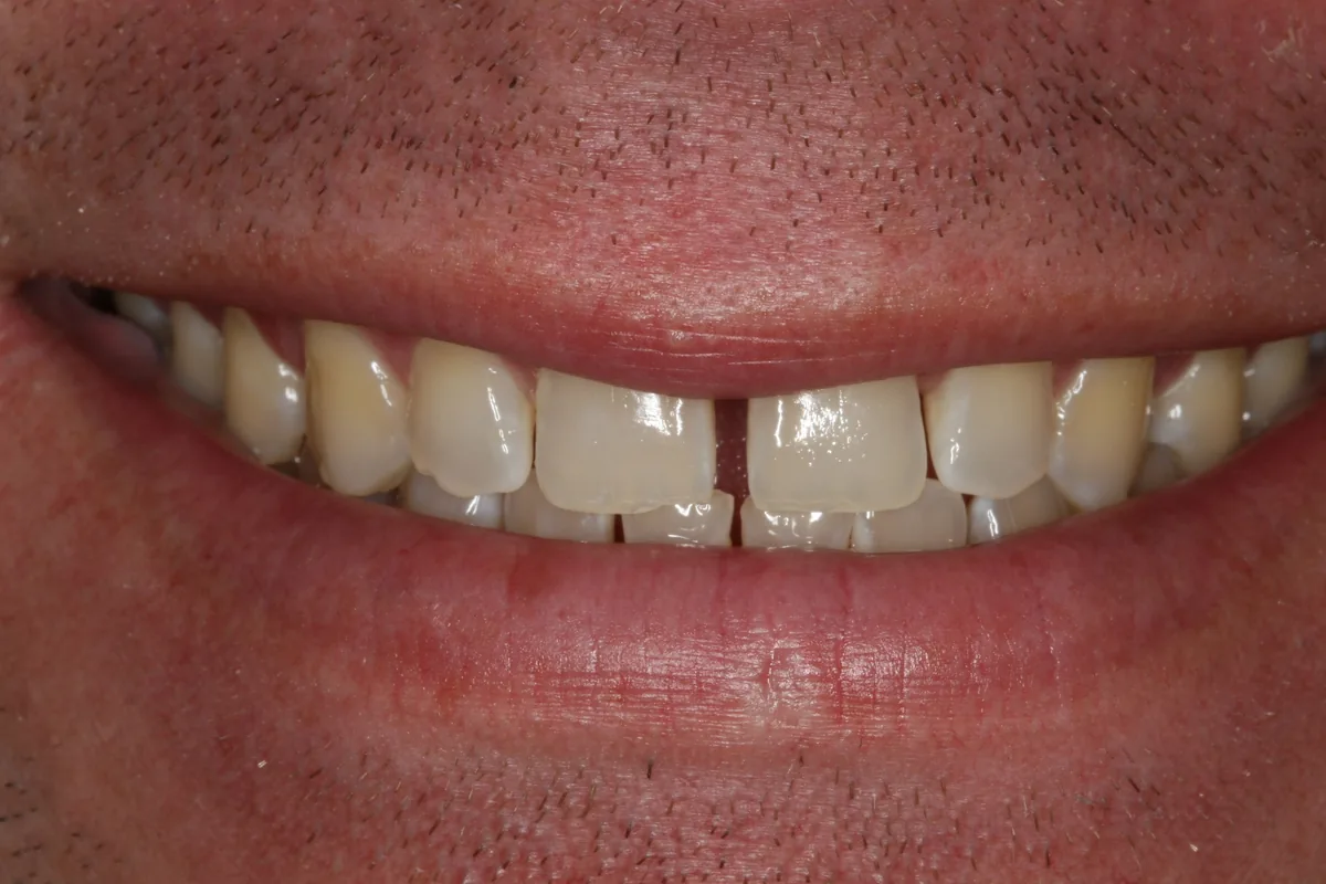 Kenny's smile transformation at Rod Gleave, DMD, before