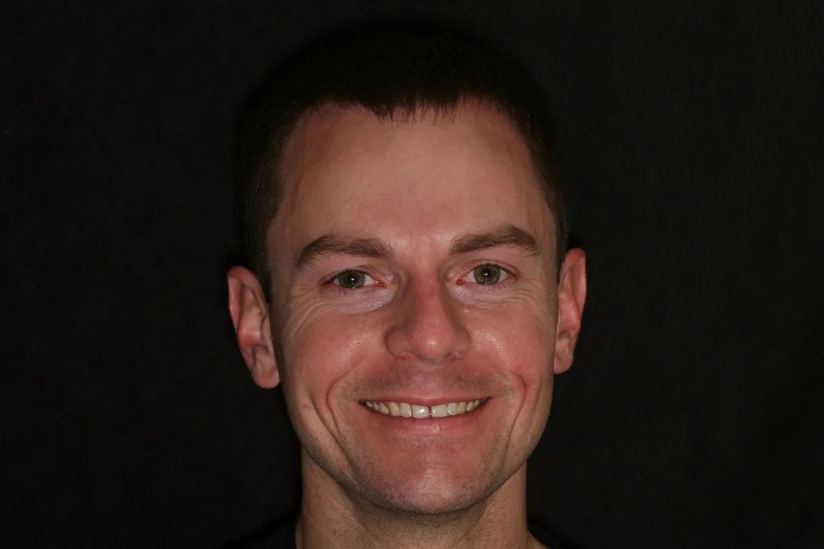 Kenny's smile transformation at Rod Gleave, DMD, before, portrait