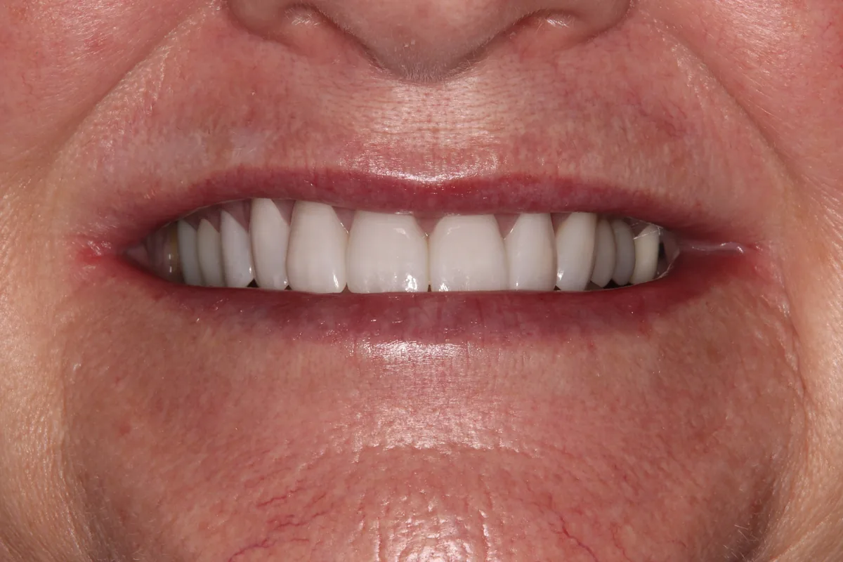 After (close-up), 7 Esthetic Crowns: Linda