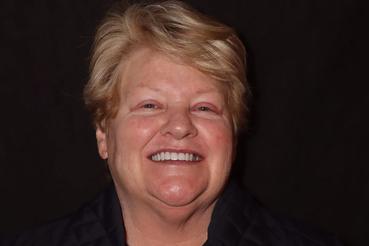 After, 7 Esthetic Crowns: Linda