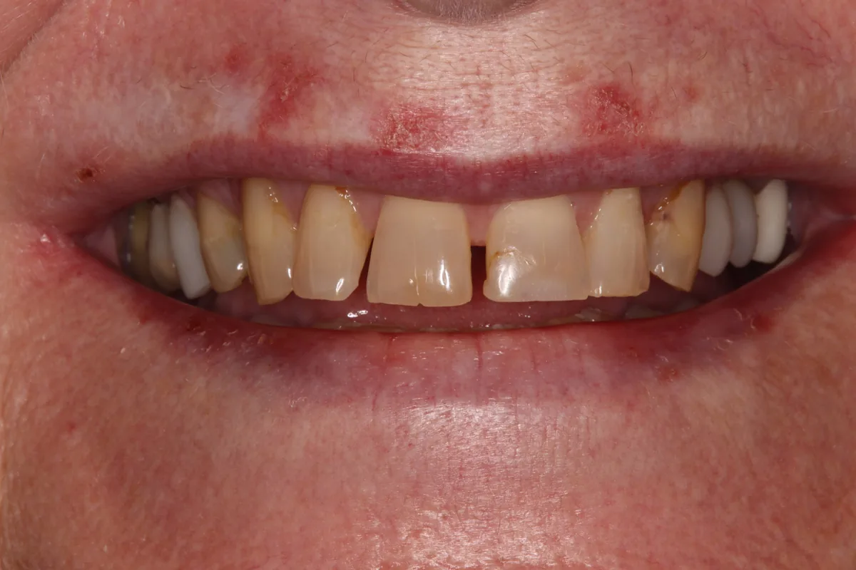 Before (close-up), 7 Esthetic Crowns: Linda