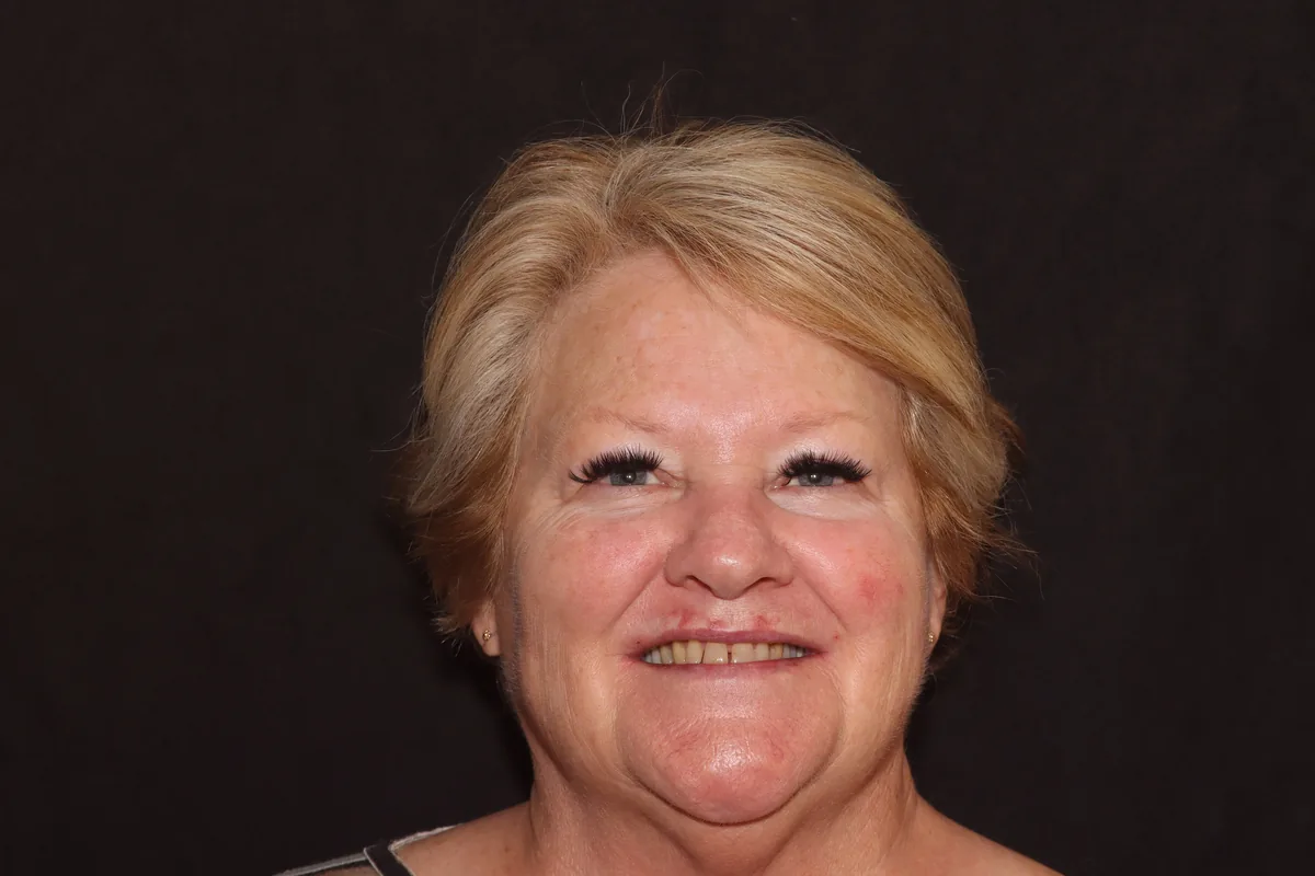 Before, 7 Esthetic Crowns: Linda