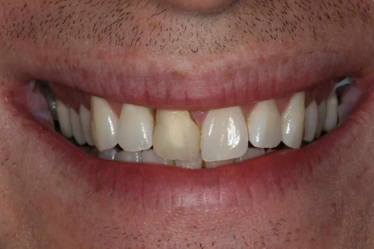 Before (close-up), 1 Esthetic Porcelain Crown: Luke