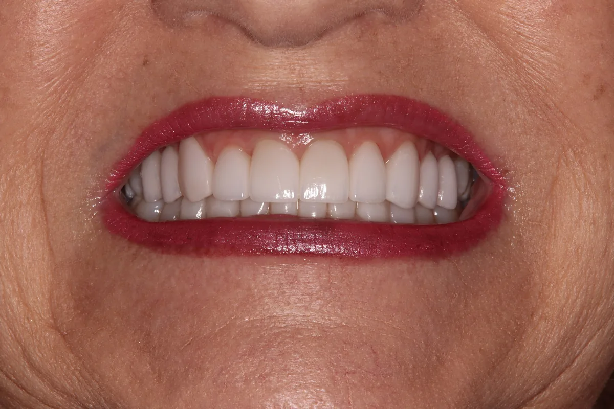 Lynette's smile transformation at Rod Gleave, DMD, after
